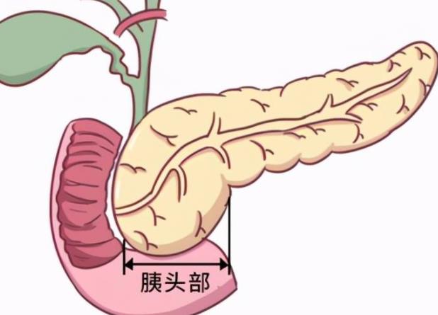 胰腺癌晚期能活多久 发病率低预后难3-6个月