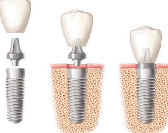 种植牙齿的后遗症有哪些 感染牙龈增生下唇麻木出血