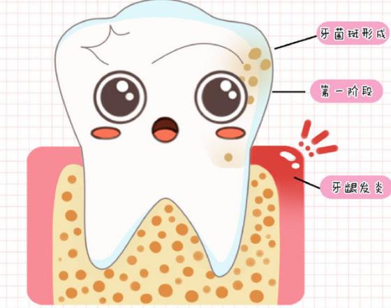 牙周炎治疗费用大概多少 600/次疗程三次局部刺激