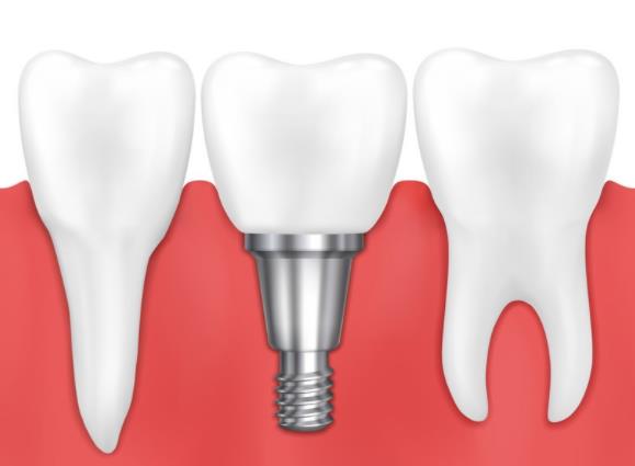 种植牙齿医保能否报销 医美修复项目假牙属特需服务费