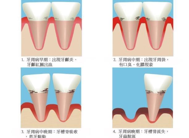 牙周炎怎么治疗 药物去除牙石杀菌手术
