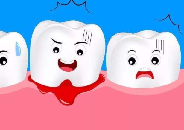 牙周炎是什么原因引起的 菌斑,牙石,创伤性咬合,食物嵌塞等