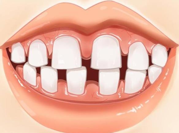 牙缝变大是怎么回事 先天性发育牙缝龋坏牙周病