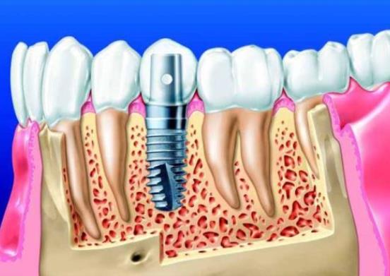 种植牙齿的步骤和时间 术前检查7-12天拆线3—6个月安装义齿