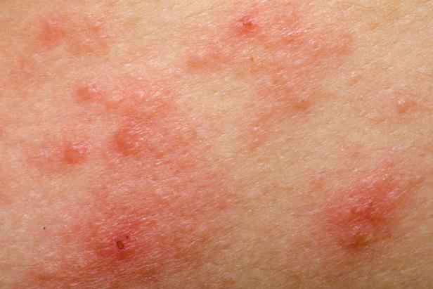 湿疹是什么原因造成的 遗传环境感染用药