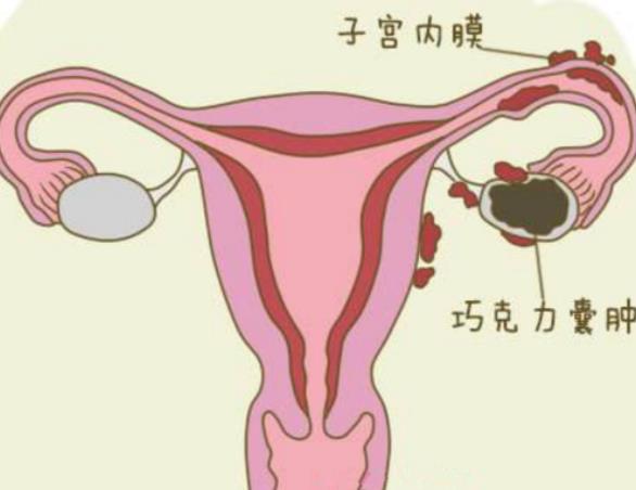 巧克力囊肿是怎么形成的 子宫内膜异位症三四十岁多见