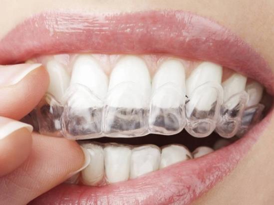 隐形牙套大概费用多少 25000-40000元每1～2个月更换