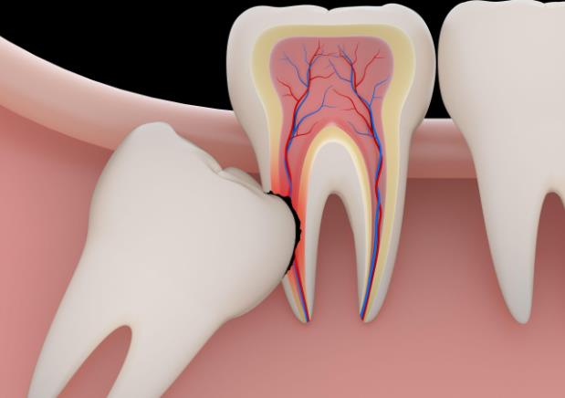 智齿长在哪个位置 口腔最内侧上下颚各两颗