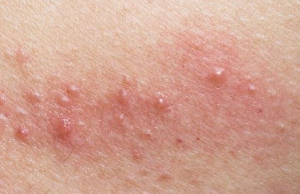 湿疹可以自愈吗 结合内外因药物干预避开过敏原