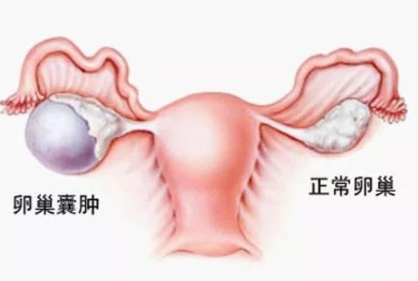 巧克力囊肿能怀上孩子吗 不孕率高达50％及时治疗