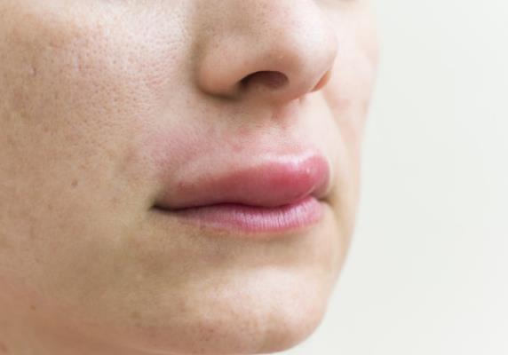 唇炎是什么原因引起的 温度化学生活习惯精神