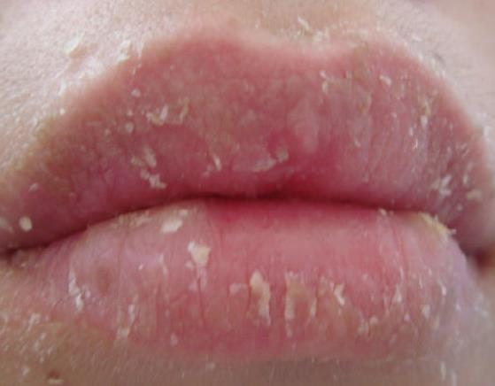 唇炎的症状有哪些 干燥脱屑瘙痒糜烂水肿充血