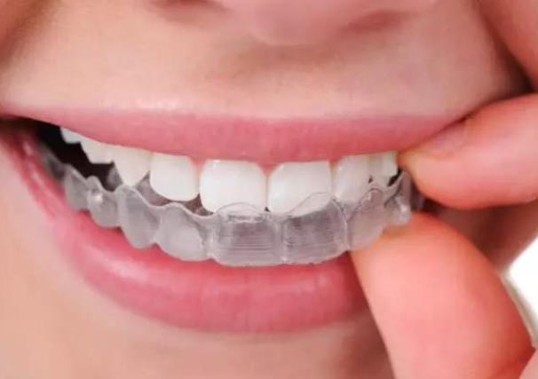 隐形牙套多久换一副 一次/每2周,每天20—22小时