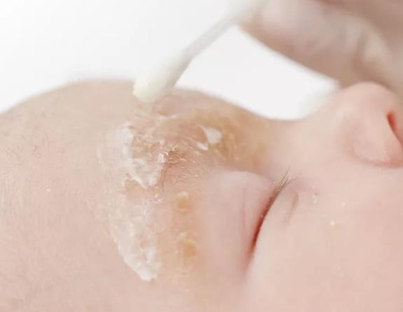 婴儿湿疹怎么处理 2%—3%硼酸开水冲泡涂抹中药擦洗