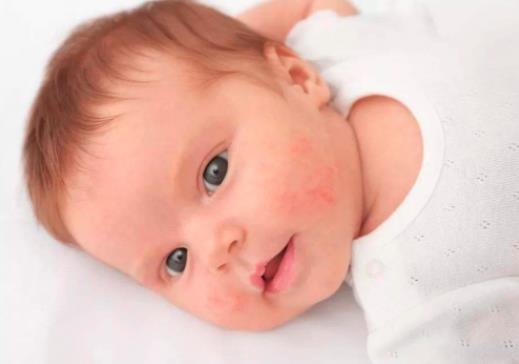 婴儿湿疹用什么药膏 红霉素软膏,维生素E软膏等