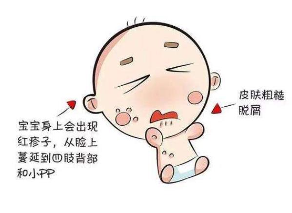 婴儿湿疹多久能好 及时干预治疗一周左右缓解