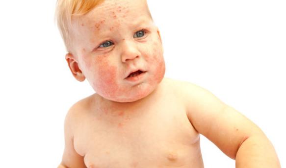 婴儿湿疹是怎么引起的 过敏环境情绪遗传等