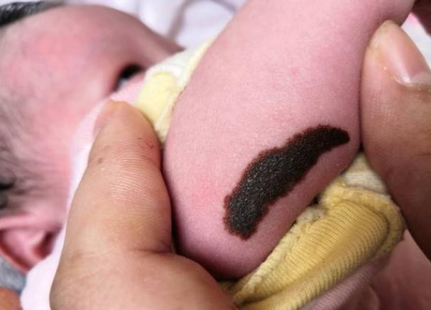 新生儿胎记是怎么形成的 皮肤组织发育异常增生